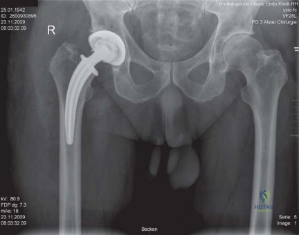 صورة طبية: استبدال مفصل الورك بتقنية الحفاظ على عنق الفخذ (CFP): نتائج أولية أفضل ورعاية متقدمة في صنعاء مع الأستاذ الدكتور محمد هطيف