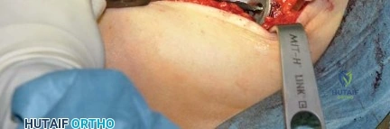 صورة طبية: استبدال مفصل الورك بتقنية الحفاظ على عنق الفخذ (CFP): نتائج أولية أفضل ورعاية متقدمة في صنعاء مع الأستاذ الدكتور محمد هطيف