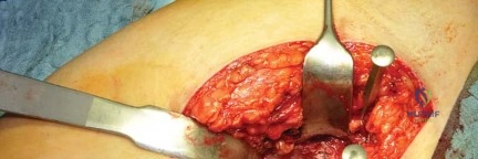 صورة طبية: استبدال مفصل الورك بتقنية الحفاظ على عنق الفخذ (CFP): نتائج أولية أفضل ورعاية متقدمة في صنعاء مع الأستاذ الدكتور محمد هطيف