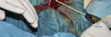 صورة طبية: استبدال مفصل الورك بتقنية الحفاظ على عنق الفخذ (CFP): نتائج أولية أفضل ورعاية متقدمة في صنعاء مع الأستاذ الدكتور محمد هطيف