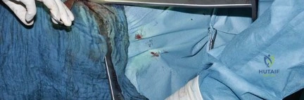 صورة طبية: استبدال مفصل الورك بتقنية الحفاظ على عنق الفخذ (CFP): نتائج أولية أفضل ورعاية متقدمة في صنعاء مع الأستاذ الدكتور محمد هطيف