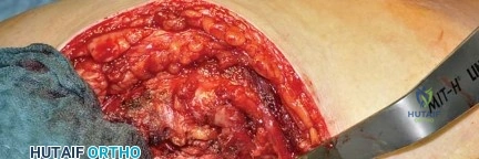 صورة طبية: استبدال مفصل الورك بتقنية الحفاظ على عنق الفخذ (CFP): نتائج أولية أفضل ورعاية متقدمة في صنعاء مع الأستاذ الدكتور محمد هطيف