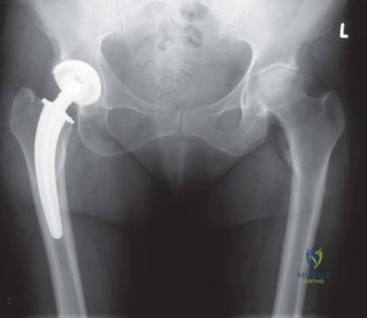 صورة طبية: استبدال مفصل الورك بتقنية الحفاظ على عنق الفخذ (CFP): نتائج أولية أفضل ورعاية متقدمة في صنعاء مع الأستاذ الدكتور محمد هطيف