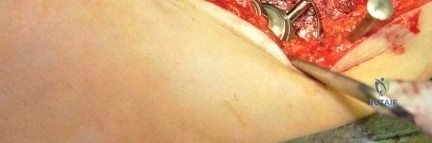صورة طبية: استبدال مفصل الورك بتقنية الحفاظ على عنق الفخذ (CFP): نتائج أولية أفضل ورعاية متقدمة في صنعاء مع الأستاذ الدكتور محمد هطيف