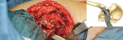 صورة طبية: استبدال مفصل الورك بتقنية الحفاظ على عنق الفخذ (CFP): نتائج أولية أفضل ورعاية متقدمة في صنعاء مع الأستاذ الدكتور محمد هطيف