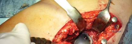 صورة طبية: استبدال مفصل الورك بتقنية الحفاظ على عنق الفخذ (CFP): نتائج أولية أفضل ورعاية متقدمة في صنعاء مع الأستاذ الدكتور محمد هطيف