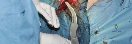صورة طبية: استبدال مفصل الورك بتقنية الحفاظ على عنق الفخذ (CFP): نتائج أولية أفضل ورعاية متقدمة في صنعاء مع الأستاذ الدكتور محمد هطيف