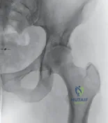 صورة توضيحية لـ إصابات مفاصل قاعدة الإبهام والأصابع (CMC): دليل شامل للتشخيص والعلاج والتعافي في صنعاء