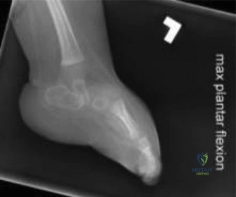 صورة توضيحية لـ القدم العمودية الخلقية (CVT): دليل شامل للآباء والعلاج المتقدم مع الأستاذ الدكتور محمد هطيف