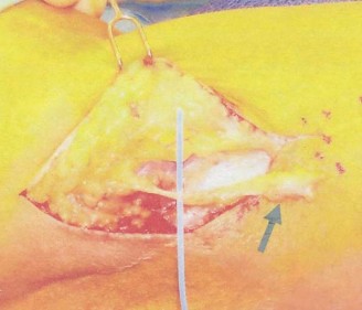Illustration 3 for Atypical Elbow Pain: Is Your Extensor Carpi Radialis the Key?