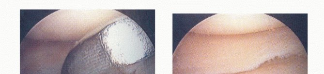 Illustration 45 for Dissecans of the Knee: What's the Difference – OCD vs. AVN?