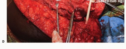 Illustration 13 for Beyond Hemipelvectomy: Preservation of the Sciatic in Buttock Surgery