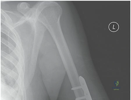 Illustration of shaft fractures humeral - Dr. Mohammed Hutaif