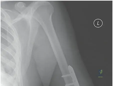 Illustration of shaft fractures humeral - Dr. Mohammed Hutaif