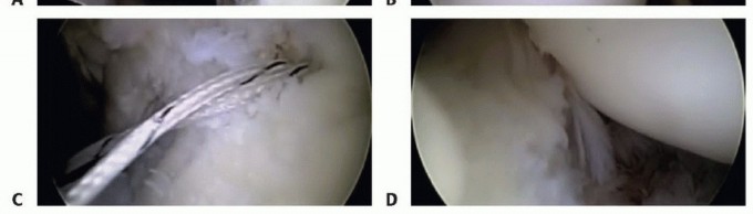 Illustration 32 for Regain Stability: Arthroscopy for Anterior Instability & the Inferior Glenohumeral Ligament