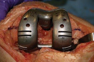 Illustration 26 for Understand Augments: The Role of Metal Augments in Arthroplasty