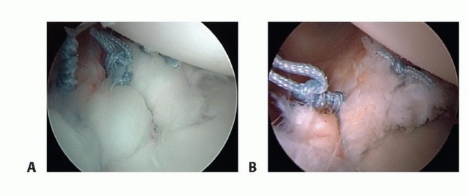 Illustration 25 for Regain Stability: Arthroscopy for Anterior Instability & the Inferior Glenohumeral Ligament
