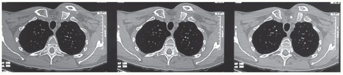 Illustration 14 for Optimizing SC Dislocation Repair After Medial Clavicle Resection