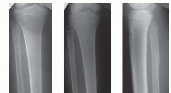 Illustration 4 for Advanced Nailing of the Mature Tibia: Overcoming Complexities