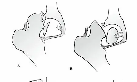 صورة توضيحية لـ كسور وخلوع رأس الفخذ: دليلك الشامل للتعافي بأمان مع الأستاذ الدكتور محمد هطيف
