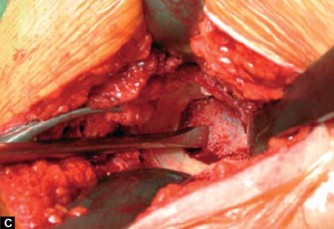 Illustration 3 for Optimizing Acetabular Component Cementation for Superior Outcomes