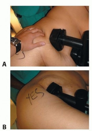 Illustration 4 for Hemiarthroplasty of the Hip: Indications & Types Explained