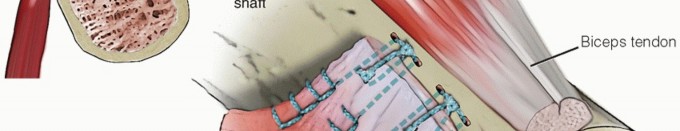 Illustration 33 for Restore Shoulder Function with Latissimus Dorsi Tendon Transfer