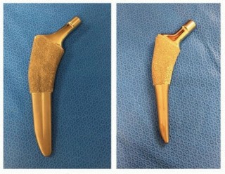 Illustration 2 for The Tapered Stem: Your Guide to Durable Cementless Hip Fixation