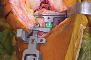 صورة طبية: استبدال مفصل الركبة بالحد الأدنى من التدخل الجراحي: ألم أقل وتعافٍ أسرع مع النهج شبه الرضفي الإنسي