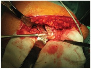 Illustration 22 for Why Polished Tapered Cemented Stems Excel in Hip Replacement