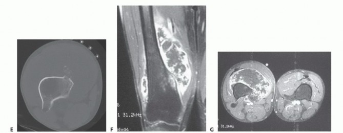 Illustration 14 for Advanced Distal Femoral Resections: Limb-Sparing Outcomes & Techniques