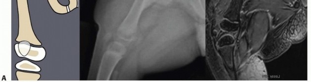 Illustration 4 for Treatment for Congenital Femoral Deficiency: What You Need to Know