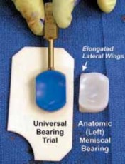 Illustration 32 for Knee Arthroplasty Unicondylar: Discover if Partial Knee Replacement is Right