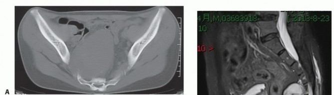 Illustration 18 for Sacral Tumor Surgery: Safeguarding Bowel & Bladder Control