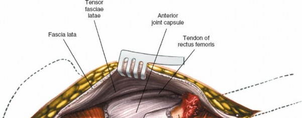 Illustration 116 for Unlocking Every Aspect of the Hip's Surgical Approaches