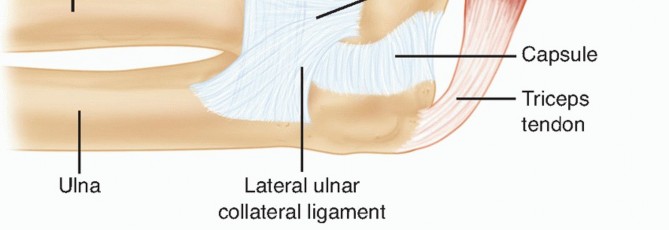 Illustration 2 for Radial Head Arthroplasty: Restoring Elbow Function & Stability