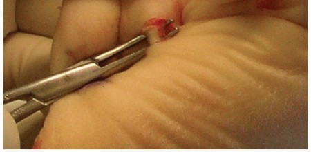 Illustration 33 for Toe Deformity Pain? Rebalance Flexor to Extensor for Relief