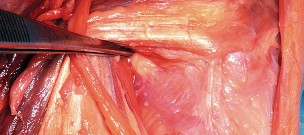 Illustration 26 for Mastering Valgus Total Knee Replacement: Techniques & Pitfalls