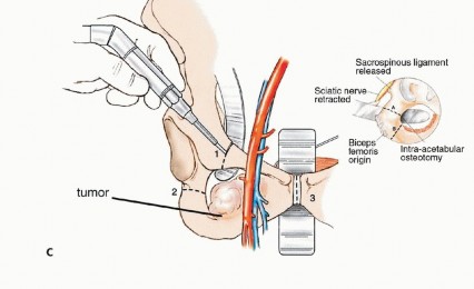 Illustration 38 for Surgical Pelvic Resection: Gluteus Maximus Muscle & Nerve Preservation