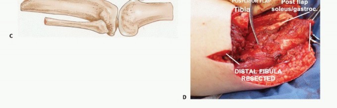 Illustration 9 for Below-Knee Amputation: Maximize Your Below-Knee Recovery & Function