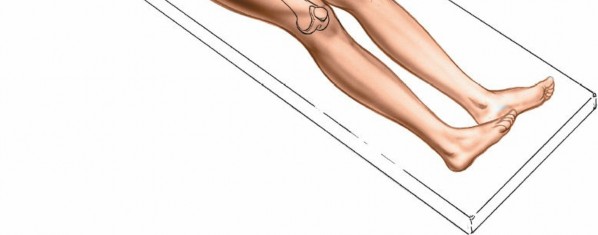 Illustration 14 for Optimal Femoral Approaches: Mastering the Lateral Intermuscular Septum