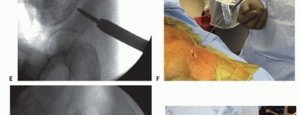 Illustration 37 for Emergency Fixation of the Pelvis: Control Bleeding & Restore Stability