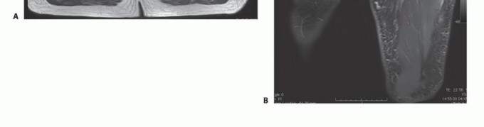 Illustration 9 for Limb-Sparing Quadriceps Resection: Superficial Femoral Artery