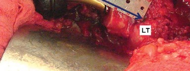 صورة طبية: إتقان توازن الأنسجة الرخوة لمفصل ورك صناعي مثالي: دليل شامل للمرضى مع الأستاذ الدكتور محمد هطيف