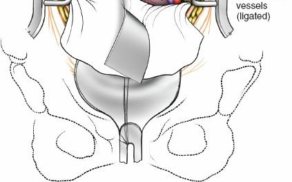 Illustration 93 for Approach to the Lumbar Spine: Mastering Techniques & Anatomy