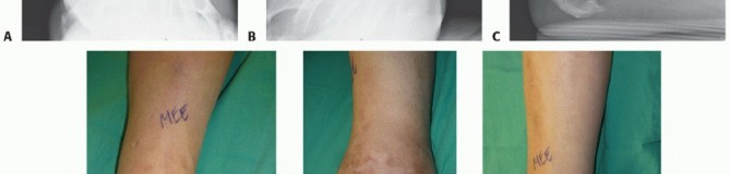 Illustration 35 for Optimize Pain Management with Proximal Ring Block for Ankle Arthrodesis