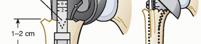 Illustration 23 for Hemiarthroplasty for Proximal: Effective Treatment for Fractures