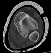 Illustration 6 for Tibial Fracture Extending into the Plafond: Intramedullary Secrets