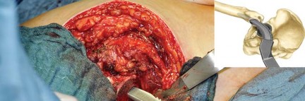 Illustration 37 for Collum Femoris Preserving: Achieve Better Primary Hip Outcomes