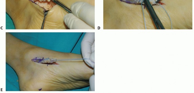 Illustration 7 for Restore Movement: Tendon Transfer for Common Peroneal Nerve Foot Drop